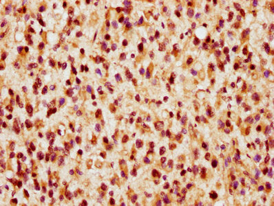 IHC image of CSB-PA858733LA01HU diluted at 1:300 and staining in paraffin-embedded human glioma performed on a Leica BondTM system. After dewaxing and hydration, antigen retrieval was mediated by high pressure in a citrate buffer (pH 6.0). Section was blocked with 10% normal goat serum 30min at RT. Then primary antibody (1% BSA) was incubated at 4&deg;C overnight. The primary is detected by a biotinylated secondary antibody and visualized using an HRP conjugated SP system.