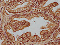 IHC image of CSB-PA859524LA01HU diluted at 1:100 and staining in paraffin-embedded human prostate cancer performed on a Leica BondTM system. After dewaxing and hydration, antigen retrieval was mediated by high pressure in a citrate buffer (pH 6.0). Section was blocked with 10% normal goat serum 30min at RT. Then primary antibody (1% BSA) was incubated at 4°C overnight. The primary is detected by a biotinylated secondary antibody and visualized using an HRP conjugated SP system.