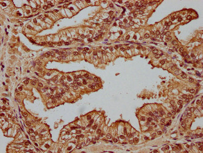 IHC image of CSB-PA859524LA01HU diluted at 1:100 and staining in paraffin-embedded human prostate cancer performed on a Leica BondTM system. After dewaxing and hydration, antigen retrieval was mediated by high pressure in a citrate buffer (pH 6.0). Section was blocked with 10% normal goat serum 30min at RT. Then primary antibody (1% BSA) was incubated at 4°C overnight. The primary is detected by a biotinylated secondary antibody and visualized using an HRP conjugated SP system.