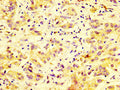 IHC image of CSB-PA859528LA01HU diluted at 1:600 and staining in paraffin-embedded human liver cancer performed on a Leica BondTM system. After dewaxing and hydration, antigen retrieval was mediated by high pressure in a citrate buffer (pH 6.0). Section was blocked with 10% normal goat serum 30min at RT. Then primary antibody (1% BSA) was incubated at 4&deg;C overnight. The primary is detected by a biotinylated secondary antibody and visualized using an HRP conjugated SP system.