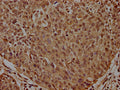 IHC image of CSB-PA860357EA01HU diluted at 1:300 and staining in paraffin-embedded human cervical cancer performed on a Leica BondTM system. After dewaxing and hydration, antigen retrieval was mediated by high pressure in a citrate buffer (pH 6.0). Section was blocked with 10% normal goat serum 30min at RT. Then primary antibody (1% BSA) was incubated at 4°C overnight. The primary is detected by a biotinylated secondary antibody and visualized using an HRP conjugated SP system.