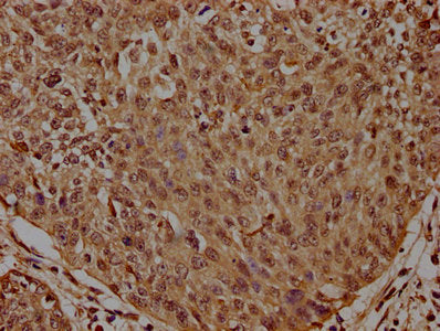 IHC image of CSB-PA860357EA01HU diluted at 1:300 and staining in paraffin-embedded human cervical cancer performed on a Leica BondTM system. After dewaxing and hydration, antigen retrieval was mediated by high pressure in a citrate buffer (pH 6.0). Section was blocked with 10% normal goat serum 30min at RT. Then primary antibody (1% BSA) was incubated at 4°C overnight. The primary is detected by a biotinylated secondary antibody and visualized using an HRP conjugated SP system.