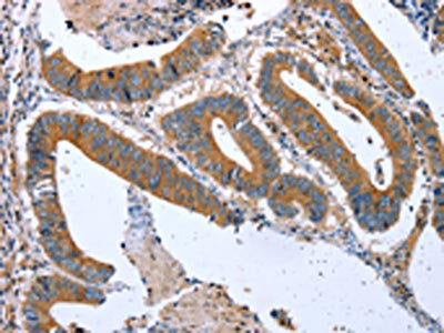 The image on the left is immunohistochemistry of paraffin-embedded Human colon cancer tissue using CSB-PA861106(CPT1A Antibody) at dilution 1/20, on the right is treated with fusion protein. (Original magnification: ×200)
