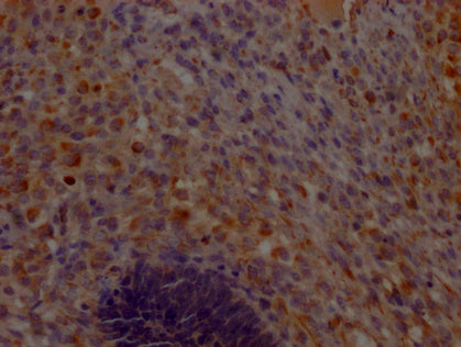IHC image of CSB-PA861130LA01HU diluted at 1:200 and staining in paraffin-embedded human ovarian cancer performed on a Leica BondTM system. After dewaxing and hydration, antigen retrieval was mediated by high pressure in a citrate buffer (pH 6.0). Section was blocked with 10% normal goat serum 30min at RT. Then primary antibody (1% BSA) was incubated at 4°C overnight. The primary is detected by a Goat anti-rabbit polymer IgG labeled by HRP and visualized using 0.05% DAB.