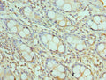Immunohistochemistry of paraffin-embedded human colon cancer using CSB-PA862043ESR2HU at dilution of 1:100