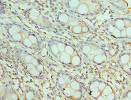 Immunohistochemistry of paraffin-embedded human colon cancer using CSB-PA862043ESR2HU at dilution of 1:100