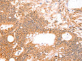 The image on the left is immunohistochemistry of paraffin-embedded Human colon cancer tissue using CSB-PA863040(LTA Antibody) at dilution 1/50, on the right is treated with fusion protein. (Original magnification: ×200)