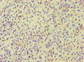 Immunohistochemistry of paraffin-embedded human breast cancer using CSB-PA863156ESR1HU at dilution of 1:100