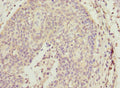 Immunohistochemistry of paraffin-embedded human cervical cancer using CSB-PA863983ESR1HU at dilution of 1:100
