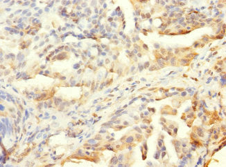 Immunohistochemistry of paraffin-embedded human lung cancer using CSB-PA865161LA01HU at dilution of 1:100