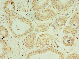 Immunohistochemistry of paraffin-embedded human breast cancer using CSB-PA865190DSR2HU at dilution of 1:100