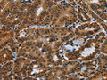 The image on the left is immunohistochemistry of paraffin-embedded Human thyroid cancer tissue using CSB-PA866060(NR3C1 Antibody) at dilution 1/40, on the right is treated with fusion protein. (Original magnification: ×200)