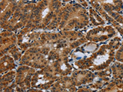 The image on the left is immunohistochemistry of paraffin-embedded Human thyroid cancer tissue using CSB-PA866060(NR3C1 Antibody) at dilution 1/40, on the right is treated with fusion protein. (Original magnification: ×200)