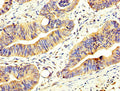 IHC image of CSB-PA866202LA01HU diluted at 1:200 and staining in paraffin-embedded human colon cancer performed on a Leica BondTM system. After dewaxing and hydration, antigen retrieval was mediated by high pressure in a citrate buffer (pH 6.0). Section was blocked with 10% normal goat serum 30min at RT. Then primary antibody (1% BSA) was incubated at 4&deg;C overnight. The primary is detected by a biotinylated secondary antibody and visualized using an HRP conjugated SP system.