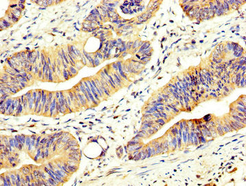 IHC image of CSB-PA866202LA01HU diluted at 1:200 and staining in paraffin-embedded human colon cancer performed on a Leica BondTM system. After dewaxing and hydration, antigen retrieval was mediated by high pressure in a citrate buffer (pH 6.0). Section was blocked with 10% normal goat serum 30min at RT. Then primary antibody (1% BSA) was incubated at 4&deg;C overnight. The primary is detected by a biotinylated secondary antibody and visualized using an HRP conjugated SP system.