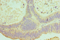 Immunohistochemistry of paraffin-embedded human colon cancer using CSB-PA867113ESR1HU at dilution of 1:100