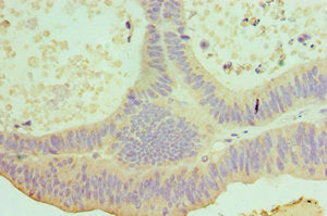 Immunohistochemistry of paraffin-embedded human colon cancer using CSB-PA867113ESR1HU at dilution of 1:100