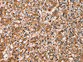 The image on the left is immunohistochemistry of paraffin-embedded Human prostate cancer tissue using CSB-PA869025(HTR3C Antibody) at dilution 1/30, on the right is treated with fusion protein. (Original magnification: ×200)
