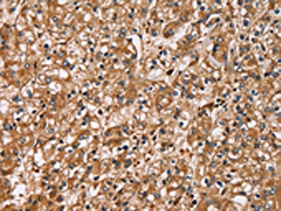The image on the left is immunohistochemistry of paraffin-embedded Human prostate cancer tissue using CSB-PA869025(HTR3C Antibody) at dilution 1/30, on the right is treated with fusion protein. (Original magnification: ×200)