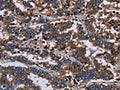The image on the left is immunohistochemistry of paraffin-embedded Human liver cancer tissue using CSB-PA869115(F11R Antibody) at dilution 1/60, on the right is treated with fusion protein. (Original magnification: ×200)
