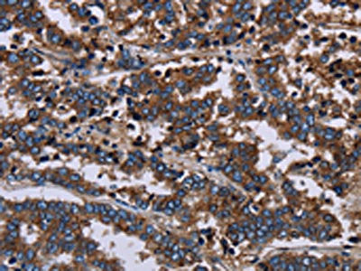 The image on the left is immunohistochemistry of paraffin-embedded Human liver cancer tissue using CSB-PA869115(F11R Antibody) at dilution 1/60, on the right is treated with fusion protein. (Original magnification: ×200)