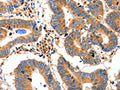 The image on the left is immunohistochemistry of paraffin-embedded Human colon cancer tissue using CSB-PA869336(IDE Antibody) at dilution 1/20, on the right is treated with fusion protein. (Original magnification: ×200)