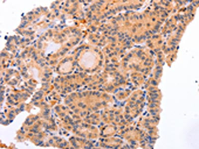 The image on the left is immunohistochemistry of paraffin-embedded Human thyroid cancer tissue using CSB-PA869503(NR3C1 Antibody) at dilution 1/25, on the right is treated with synthetic peptide. (Original magnification: ×200)