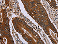 The image on the left is immunohistochemistry of paraffin-embedded Human colon cancer tissue using CSB-PA869662(JUP Antibody) at dilution 1/40, on the right is treated with fusion protein. (Original magnification: ×200)