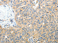 The image on the left is immunohistochemistry of paraffin-embedded Human ovarian cancer tissue using CSB-PA869855(RAMP3 Antibody) at dilution 1/40, on the right is treated with fusion protein. (Original magnification: ×200)