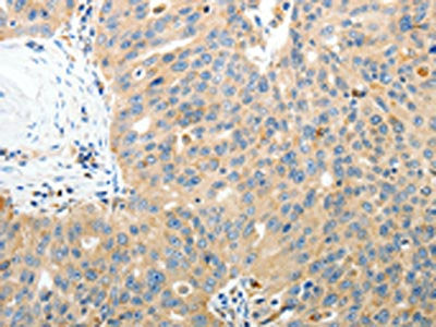 The image on the left is immunohistochemistry of paraffin-embedded Human ovarian cancer tissue using CSB-PA869855(RAMP3 Antibody) at dilution 1/40, on the right is treated with fusion protein. (Original magnification: ×200)