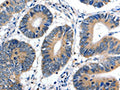The image on the left is immunohistochemistry of paraffin-embedded Human colon cancer tissue using CSB-PA869915(CDKN1B Antibody) at dilution 1/20, on the right is treated with fusion protein. (Original magnification: X200)