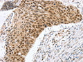 The image on the left is immunohistochemistry of paraffin-embedded Human esophagus cancer tissue using CSB-PA870281(RNF20 Antibody) at dilution 1/25, on the right is treated with fusion protein. (Original magnification: ×200)