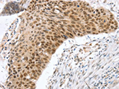 The image on the left is immunohistochemistry of paraffin-embedded Human esophagus cancer tissue using CSB-PA870281(RNF20 Antibody) at dilution 1/25, on the right is treated with fusion protein. (Original magnification: ×200)