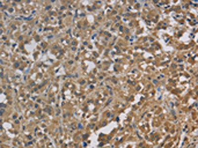 The image on the left is immunohistochemistry of paraffin-embedded Human thyroid cancer tissue using CSB-PA870342(CYB5A Antibody) at dilution 1/30, on the right is treated with fusion protein. (Original magnification: ×200)
