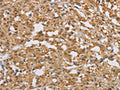 The image on the left is immunohistochemistry of paraffin-embedded Human thyroid cancer tissue using CSB-PA870531(DIDO1 Antibody) at dilution 1/50, on the right is treated with fusion protein. (Original magnification: ×200)