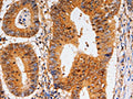 The image on the left is immunohistochemistry of paraffin-embedded Human colon cancer tissue using CSB-PA871419(CDK6 Antibody) at dilution 1/10, on the right is treated with fusion protein. (Original magnification: ×200)