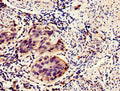 Immunohistochemistry of paraffin-embedded human bladder cancer using CSB-PA872492LA01HU at dilution of 1:100