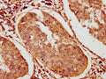 IHC image of CSB-PA872503LA01HU diluted at 1:400 and staining in paraffin-embedded human cervical cancer performed on a Leica BondTM system. After dewaxing and hydration, antigen retrieval was mediated by high pressure in a citrate buffer&nbsp;(pH 6.0). Section was blocked with 10% normal goat serum 30min at RT. Then primary antibody&nbsp;(1% BSA) was incubated at 4&deg;C overnight. The primary is detected by a biotinylated secondary antibody and visualized using an HRP conjugated SP system.