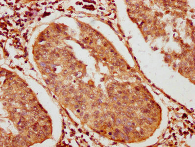 IHC image of CSB-PA872503LA01HU diluted at 1:400 and staining in paraffin-embedded human cervical cancer performed on a Leica BondTM system. After dewaxing and hydration, antigen retrieval was mediated by high pressure in a citrate buffer&nbsp;(pH 6.0). Section was blocked with 10% normal goat serum 30min at RT. Then primary antibody&nbsp;(1% BSA) was incubated at 4&deg;C overnight. The primary is detected by a biotinylated secondary antibody and visualized using an HRP conjugated SP system.