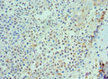 Immunohistochemistry of paraffin-embedded human breast cancer using CSB-PA872537ESR1HU at dilution of 1:100