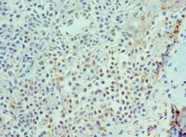 Immunohistochemistry of paraffin-embedded human breast cancer using CSB-PA872537ESR1HU at dilution of 1:100