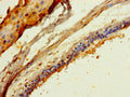 Immunohistochemistry of paraffin-embedded human breast cancer using CSB-PA873727LA01HU at dilution of 1:100