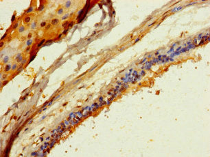 Immunohistochemistry of paraffin-embedded human breast cancer using CSB-PA873727LA01HU at dilution of 1:100