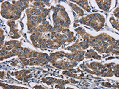 The image is immunohistochemistry of paraffin-embedded Human breast cancer tissue using CSB-PA874417(AGER Antibody) at dilution 1/70. (Original magnification: ×200)