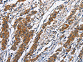The image on the left is immunohistochemistry of paraffin-embedded Human gastic cancer tissue using CSB-PA874494(NCAPD3 Antibody) at dilution 1/50, on the right is treated with fusion protein. (Original magnification: ×200)