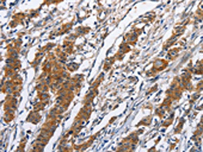The image on the left is immunohistochemistry of paraffin-embedded Human gastic cancer tissue using CSB-PA874494(NCAPD3 Antibody) at dilution 1/50, on the right is treated with fusion protein. (Original magnification: ×200)
