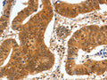 The image on the left is immunohistochemistry of paraffin-embedded Human colon cancer tissue using CSB-PA874773(SPDEF Antibody) at dilution 1/60, on the right is treated with fusion protein. (Original magnification: ×200)
