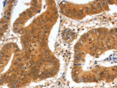 The image on the left is immunohistochemistry of paraffin-embedded Human colon cancer tissue using CSB-PA874773(SPDEF Antibody) at dilution 1/60, on the right is treated with fusion protein. (Original magnification: ×200)