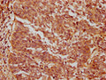 IHC image of CSB-PA874795LA01HU diluted at 1:200 and staining in paraffin-embedded human cervical cancer performed on a Leica BondTM system. After dewaxing and hydration, antigen retrieval was mediated by high pressure in a citrate buffer (pH 6.0). Section was blocked with 10% normal goat serum 30min at RT. Then primary antibody (1% BSA) was incubated at 4°C overnight. The primary is detected by a biotinylated secondary antibody and visualized using an HRP conjugated SP system.