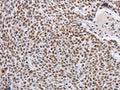 The image on the left is immunohistochemistry of paraffin-embedded Human lung cancer tissue using CSB-PA876114(THOC7 Antibody) at dilution 1/30, on the right is treated with fusion protein. (Original magnification: ×200)